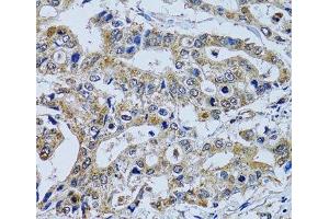 Immunohistochemistry of paraffin-embedded Human colon carcinoma using TPPP3 Polyclonal Antibody at dilution of 1:100 (40x lens). (TPPP3 anticorps)