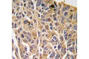 Immunohistochemistry analysis in human lung carcinoma tissue (Formalin-fixed, Paraffin-embedded) using RIPK3 / RIP3  Antibody (N-term), followed by peroxidase-conjugated secondary antibody and DAB staining. (RIPK3 anticorps  (N-Term))