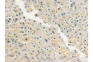 ABIN6260459 and ABIN6277817 at 1/100 staining human hepatocellular carcinoma by IHC-P.