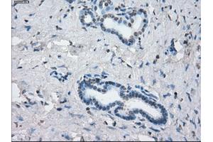 Immunohistochemical staining of paraffin-embedded Adenocarcinoma of colon tissue using anti-KDM4C mouse monoclonal antibody. (KDM4C anticorps)