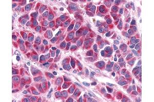 Anti-RORA / ROR Alpha antibody IHC of human Skin, Melanoma.