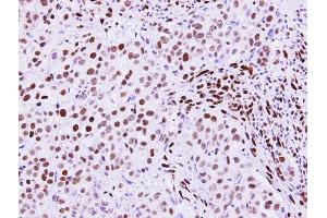 IHC-P Image RecQ1 antibody [N1N2], N-term detects RecQ1 protein at nucleus on human breast carcinoma by immunohistochemical analysis.