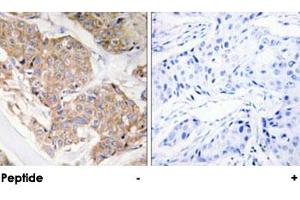 Immunohistochemical analysis of paraffin-embedded human breast carcinoma tissue using IL13RA1 polyclonal antibody . (IL13 Receptor alpha 1 anticorps)