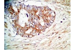 Human stomach cancer tissue was stained by rabbit Anti-Spexin prepro (36-58)  (H) Antiserum (Spexin anticorps  (Preproprotein))