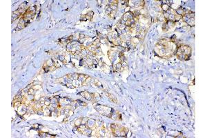 IHC analysis of beta Catenin using anti-beta Catenin antibody .