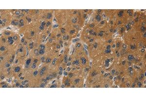 Immunohistochemistry of paraffin-embedded Human liver cancer tissue using DUSP23 Polyclonal Antibody at dilution 1:30 (DUSP23 anticorps)