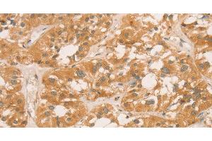 Immunohistochemistry of paraffin-embedded Human thyroid cancer tissue using CPB1 Polyclonal Antibody at dilution of 1:60