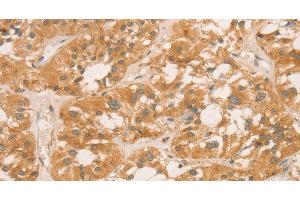 Immunohistochemistry of paraffin-embedded Human thyroid cancer tissue using CPB1 Polyclonal Antibody at dilution of 1:60 (CPB1 anticorps)