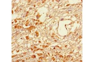 Immunohistochemistry of paraffin-embedded human melanoma using ABIN7159268 at dilution of 1:100 (MAGEA5 anticorps  (AA 1-124))