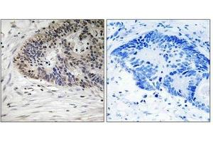 Immunohistochemistry analysis of paraffin-embedded human colon carcinoma tissue using MDM4 (Phospho-Ser367) antibody.