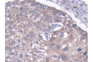 DAB staining on IHC-P; Samples: Human Liver cancer Tissue (MAP1B anticorps  (AA 2207-2468))