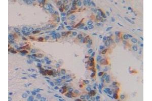 Detection of TGFa in Human Prostate Tissue using Polyclonal Antibody to Transforming Growth Factor Alpha (TGFa) (TGFA anticorps  (AA 24-98))