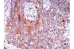 Immunohistochemical analysis of paraffin-embedded cervical cancer tissues using CPV-VP2 mouse mAb with DAB staining. (CPV-VP2 (AA 1-128) anticorps)