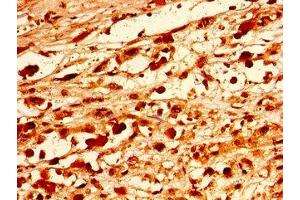 Immunohistochemistry of paraffin-embedded human melanoma using ABIN7162511 at dilution of 1:100 (PAX9 anticorps  (AA 163-336))
