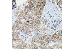 Immunohistochemistry of paraffin-embedded human breast cancer using CD147/CD147/BSG Rabbit pAb (ABIN3022146, ABIN3022147, ABIN1512647 and ABIN6218629) at dilution of 1:100 (40x lens).
