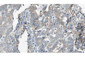 ABIN6276761 at 1/100 staining Human cervical cancer tissue by IHC-P. (TAP2 anticorps  (Internal Region))
