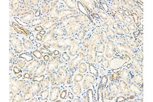 ABIN6259262 and ABIN6275240 at 1/100 staining Human kidney cancer and adjacent normal tissues by IHC-P.