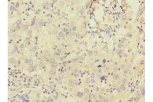 Immunohistochemistry of paraffin-embedded human liver cancer using ABIN7146291 at dilution of 1:100 (Calcitonin Receptor anticorps  (AA 25-148))