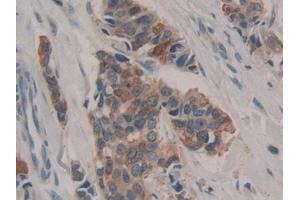 Detection of GAL3ST1 in Human Breast cancer Tissue using Polyclonal Antibody to Galactose-3-O-Sulfotransferase 1 (GAL3ST1)