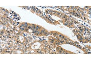 Immunohistochemistry of paraffin-embedded Human gasrtic cancer tissue using ANKZF1 Polyclonal Antibody at dilution 1:40 (ANKZF1 anticorps)