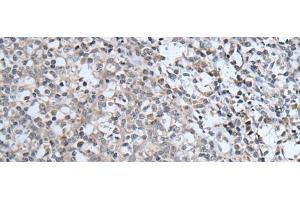 Immunohistochemistry of paraffin-embedded Human tonsil tissue using ABCA6 Polyclonal Antibody at dilution of 1:40(x200) (ABCA6 anticorps)