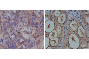 Immunohistochemical analysis of paraffin-embedded human breast carcinoma (left) and kidney carcinoma (right), showing cytoplasmic localization using GAPDH antibody with DAB staining. (GAPDH anticorps)