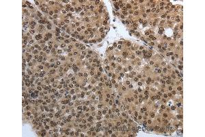 Immunohistochemistry of Human thyroid cancer using SMAD7 Polyclonal Antibody at dilution of 1:40 (SMAD7 anticorps)