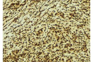 ABIN6274149 at 1/100 staining Human breast cancer tissue by IHC-P. (HMGN2 anticorps  (Internal Region))
