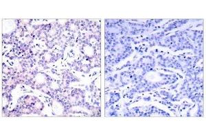 Immunohistochemical analysis of paraffin-embedded human breast carcinoma tissue using NF-κB p105/p50 (Ab-893) antibody (E021018). (NFKB1 anticorps)
