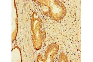 Immunohistochemistry of paraffin-embedded human prostate cancer using ABIN7156421 at dilution of 1:100 (INTS9 anticorps  (AA 368-658))