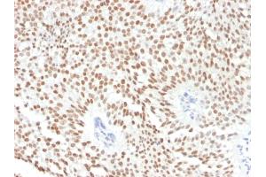 Formalin-fixed, paraffin-embedded human Bladder Carcinoma stained with FOXA1 Monoclonal Antibody (FOXA1/1241). (FOXA1 anticorps  (AA 372-472))