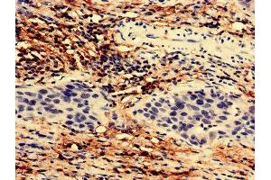Immunohistochemistry analysis of human bladder cancer using ABIN7171814 at dilution of 1:100 (TEX43 anticorps  (AA 1-134))