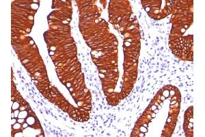 Formalin-fixed, paraffin-embedded colon carcinoma stained with Cytokeratin 19 Mouse Monoclonal Antibody (A53-B/A2.