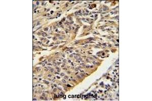 CTSE Antibody (Center) (ABIN390486 and ABIN2840847) IHC analysis in formalin fixed and paraffin embedded human lung carcinoma followed by peroxidase conjugation of the secondary antibody and DAB staining.