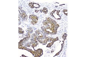 IHC analysis of Cytokeratin 19 using anti-Cytokeratin 19 antibody .