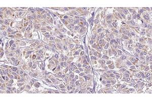 ABIN6278898 at 1/100 staining Human Melanoma tissue by IHC-P. (IL28B anticorps)