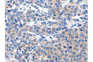The image on the left is immunohistochemistry of paraffin-embedded Human liver cancer tissue using ABIN7191181(KCNH8 Antibody) at dilution 1/15, on the right is treated with synthetic peptide.