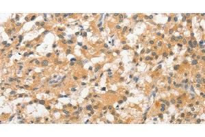 Immunohistochemistry of paraffin-embedded Human thyroid cancer tissue using STAM Polyclonal Antibody at dilution 1:40 (STAM anticorps)