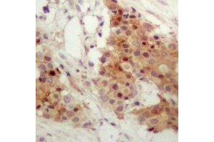Immunohistochemical analysis of IRF3 (pS385) staining in human breast cancer formalin fixed paraffin embedded tissue section. (IRF3 anticorps  (C-Term, pSer385))