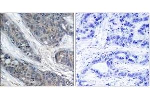 Immunohistochemistry analysis of paraffin-embedded human breast carcinoma, using IRS-1 (Phospho-Ser307) Antibody. (IRS1 anticorps  (pSer307))