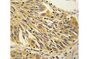 IHC analysis of FFPE human lung carcinoma with IL-1B antibody