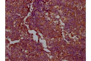 IHC image of ABIN7127769 diluted at 1:100 and staining in paraffin-embedded human lung cancer performed on a Leica BondTM system. (Recombinant PKM anticorps)