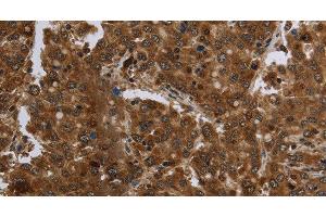 Immunohistochemistry of paraffin-embedded Human liver cancer tissue using FASTKD1 Polyclonal Antibody at dilution 1:60 (FASTKD1 anticorps)