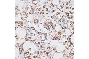 Immunohistochemistry of paraffin-embedded human breast cancer using KIF14 antibody (ABIN6129691, ABIN6142854, ABIN6142855 and ABIN6214465) at dilution of 1:100 (40x lens).