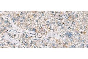 Immunohistochemistry of paraffin-embedded Human liver cancer tissue using ARIH1 Polyclonal Antibody at dilution of 1:30(x200) (ARIH1 anticorps)