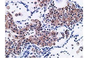 Immunohistochemical staining of paraffin-embedded Adenocarcinoma of Human breast tissue using anti-CD80 mouse monoclonal antibody. (CD80 anticorps)