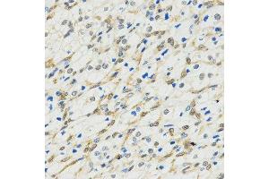 Immunohistochemistry of paraffin-embedded human kidney cancer tissue using MYSM1 antibody at dilution of 1:200 (x400 lens). (MYSM1 anticorps  (C-Term))