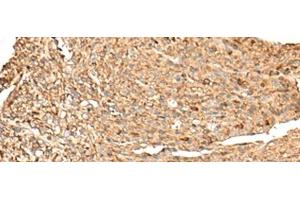 Immunohistochemistry of paraffin-embedded Human liver cancer tissue using RPS12 Polyclonal Antibody at dilution of 1:70(x200)