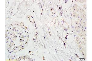 Formalin-fixed and paraffin embedded human colon carcinoma labeled with Anti-SLC5A8 Polyclonal Antibody, Unconjugated (ABIN762521) at 1:200 followed by conjugation to the secondary antibody and DAB staining. (SLC5A8 anticorps  (AA 301-400))