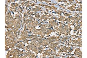 The image on the left is immunohistochemistry of paraffin-embedded Human breast cancer tissue using ABIN7192325(SERPINA11 Antibody) at dilution 1/35, on the right is treated with synthetic peptide.